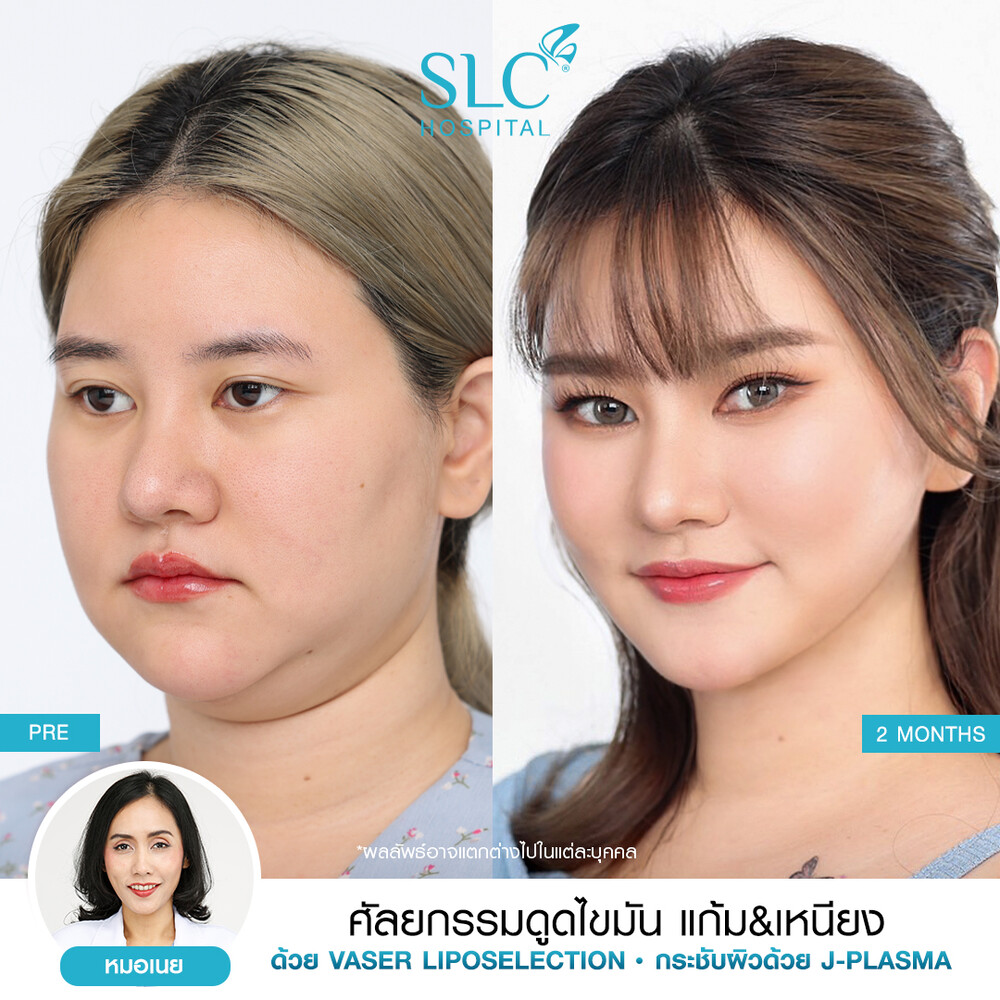 Before and After Result